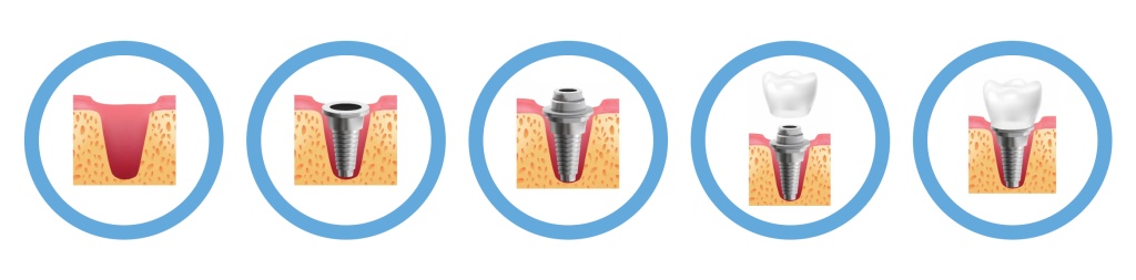 Этапы установки зубного импланта