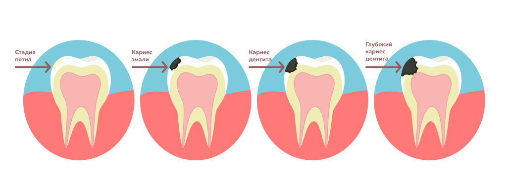 Кариес.png