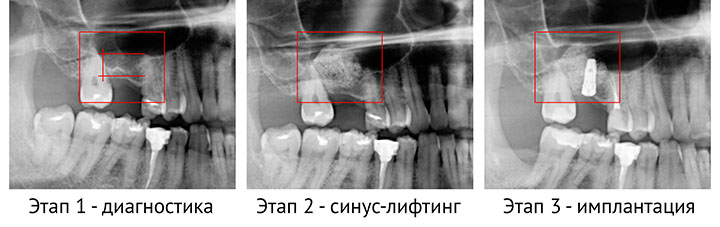 Синус-лифтинг для имплантации